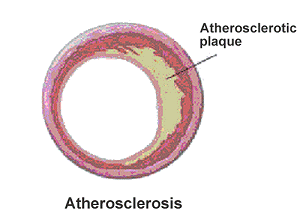 Diagram showing atherosclerosis