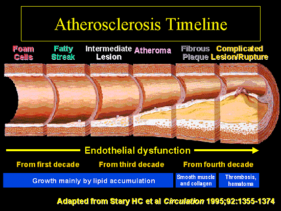 Diagram - Atherosclerosis timeframe