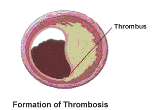 Diagram showing formation of thrombosis