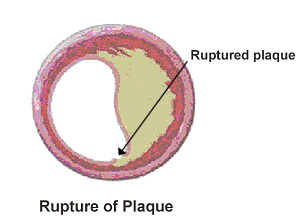 Diagram showing rupture of plaque